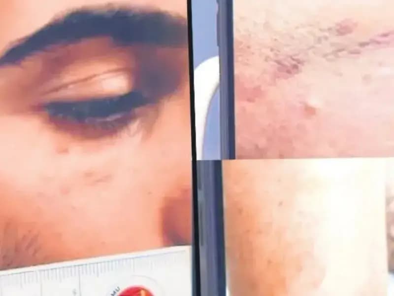 Enes Güran’ın Kolundaki Isırık İzi ve Göz Çevresindeki Morluklar Gündemde