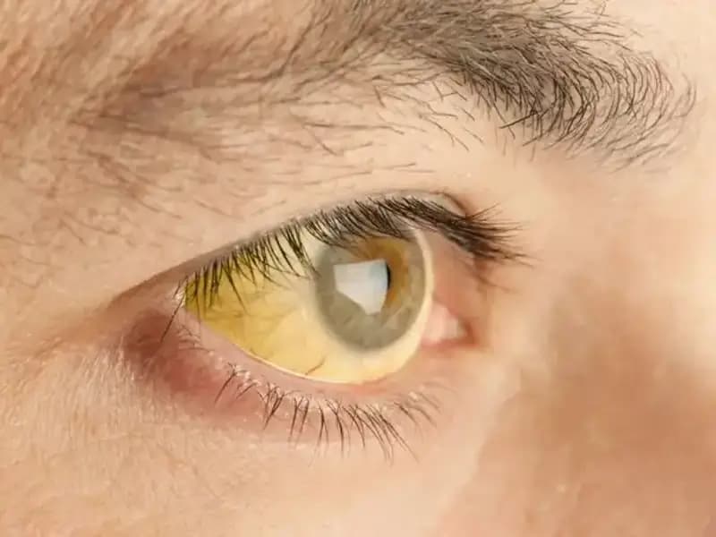 Karaciğer Sağlığınız Hakkında Bilmeniz Gereken 5 Alarm Niteliğindeki Belirti