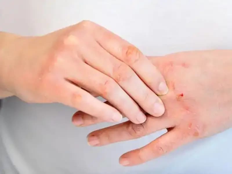 Yetersiz Protein Tüketimi: 6 Belirtilere Dikkat Edin!