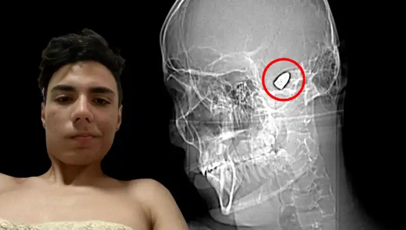Kafasında Patlayıcıyla Yaşayan Adamın Hikayesi Sosyal Medyayı Salladı